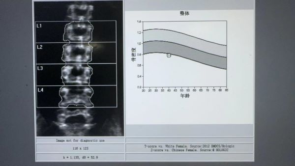 【健康科普】帶您了解骨密度